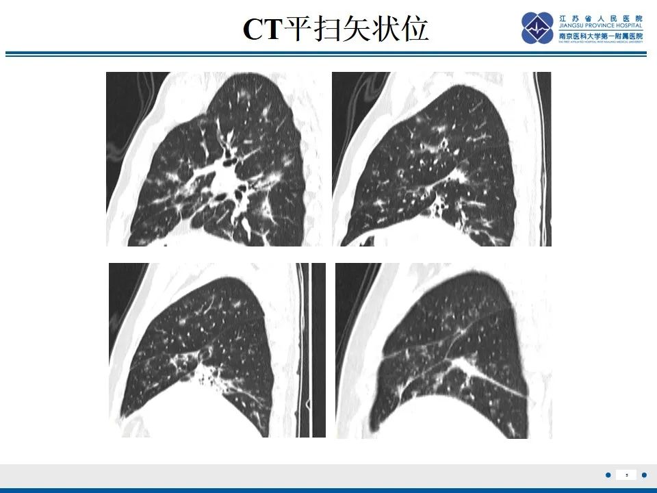 影像PPT - 【PPT】免疫检查点抑制剂相关性肺炎影像表现-6