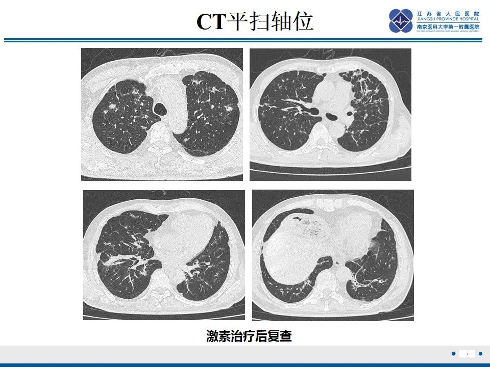 影像PPT - 【PPT】免疫检查点抑制剂相关性肺炎影像表现-8