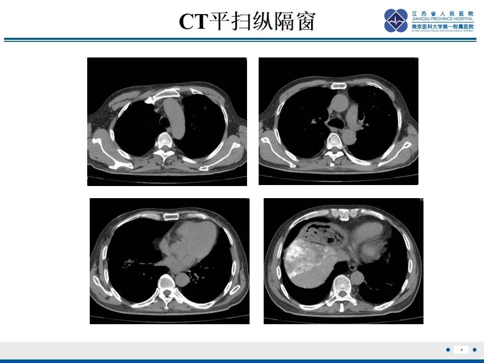 影像PPT - 【PPT】免疫检查点抑制剂相关性肺炎影像表现-9