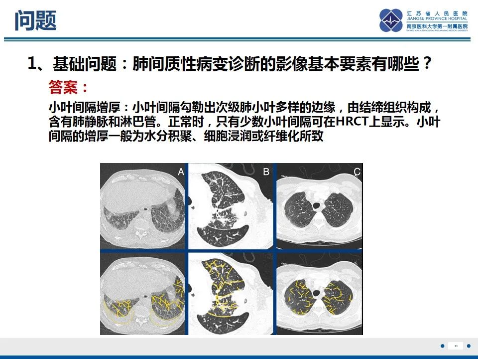 影像PPT - 【PPT】免疫检查点抑制剂相关性肺炎影像表现-12