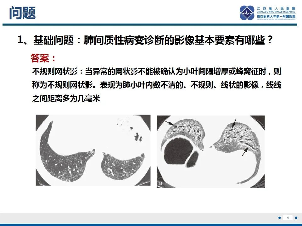 影像PPT - 【PPT】免疫检查点抑制剂相关性肺炎影像表现-13