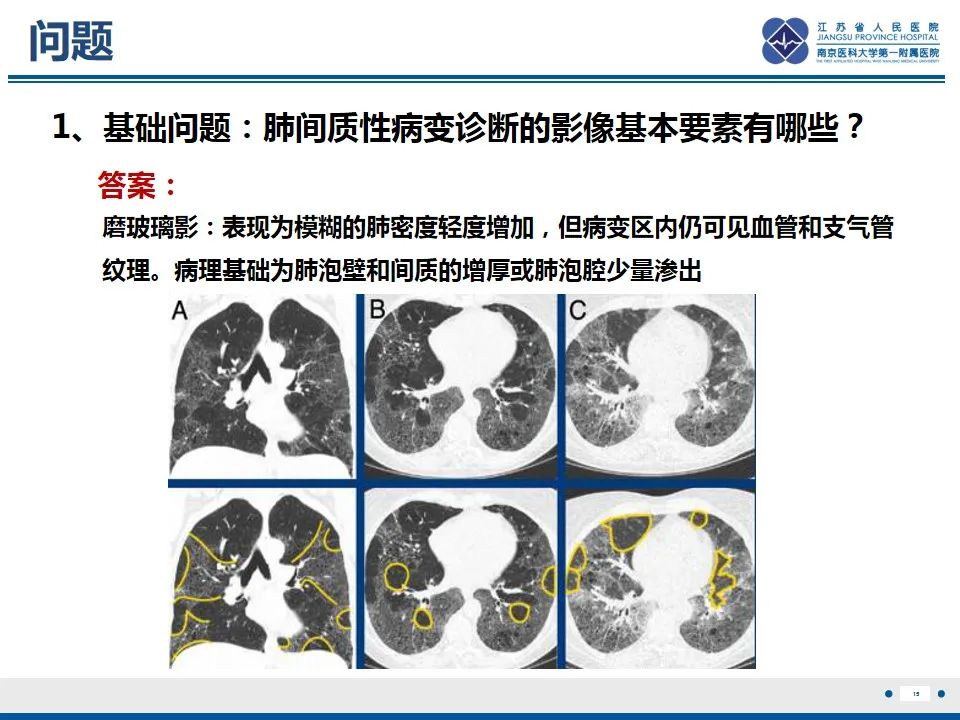 影像PPT - 【PPT】免疫检查点抑制剂相关性肺炎影像表现-16