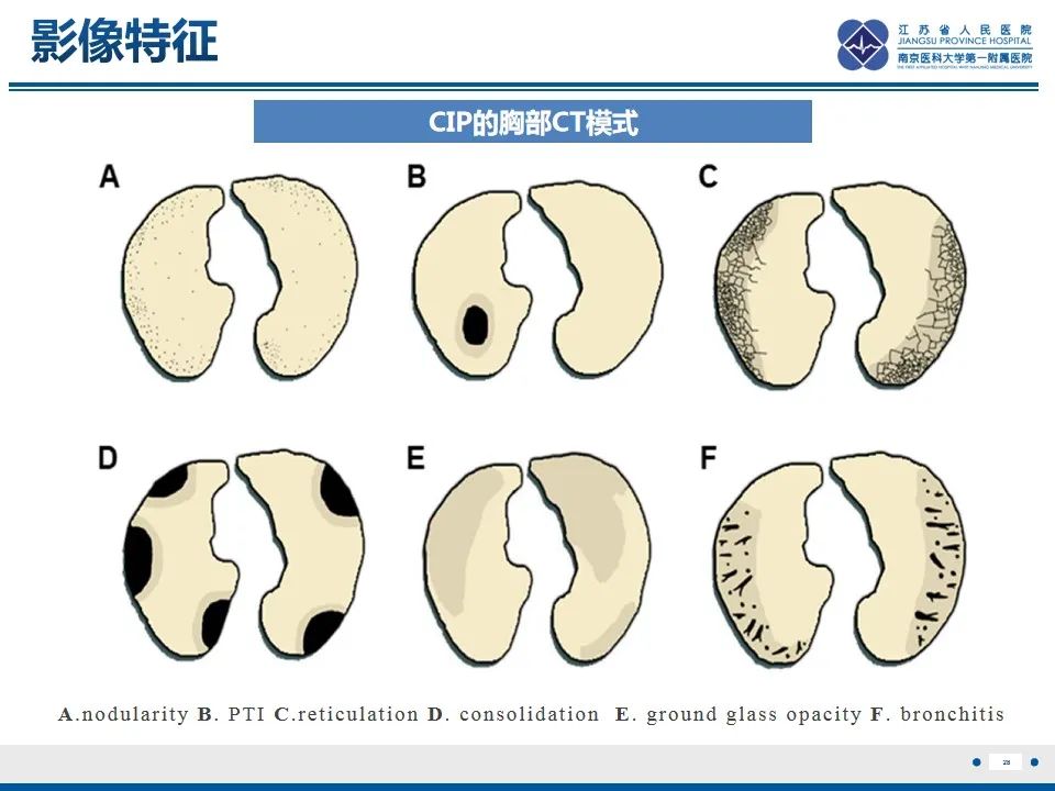 影像PPT - 【PPT】免疫检查点抑制剂相关性肺炎影像表现-29