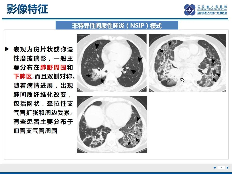 影像PPT - 【PPT】免疫检查点抑制剂相关性肺炎影像表现-31