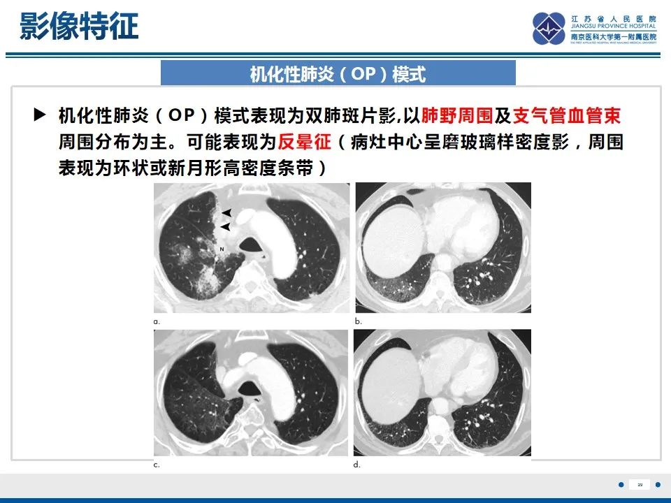 影像PPT - 【PPT】免疫检查点抑制剂相关性肺炎影像表现-30