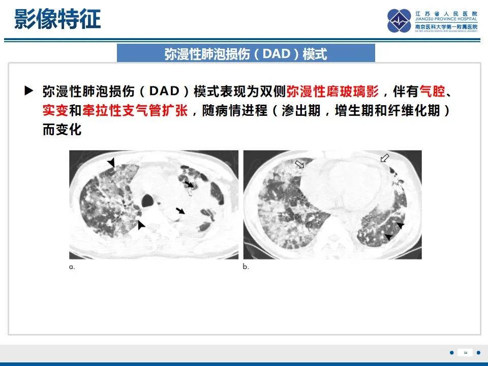 影像PPT - 【PPT】免疫检查点抑制剂相关性肺炎影像表现-33