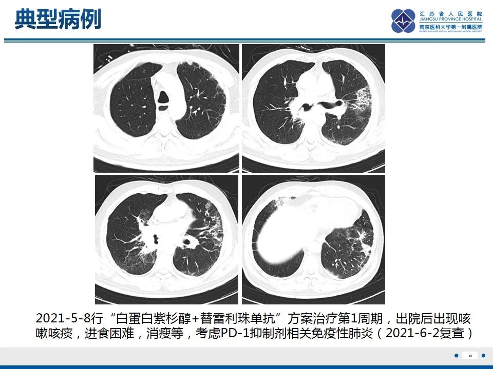 影像PPT - 【PPT】免疫检查点抑制剂相关性肺炎影像表现-40