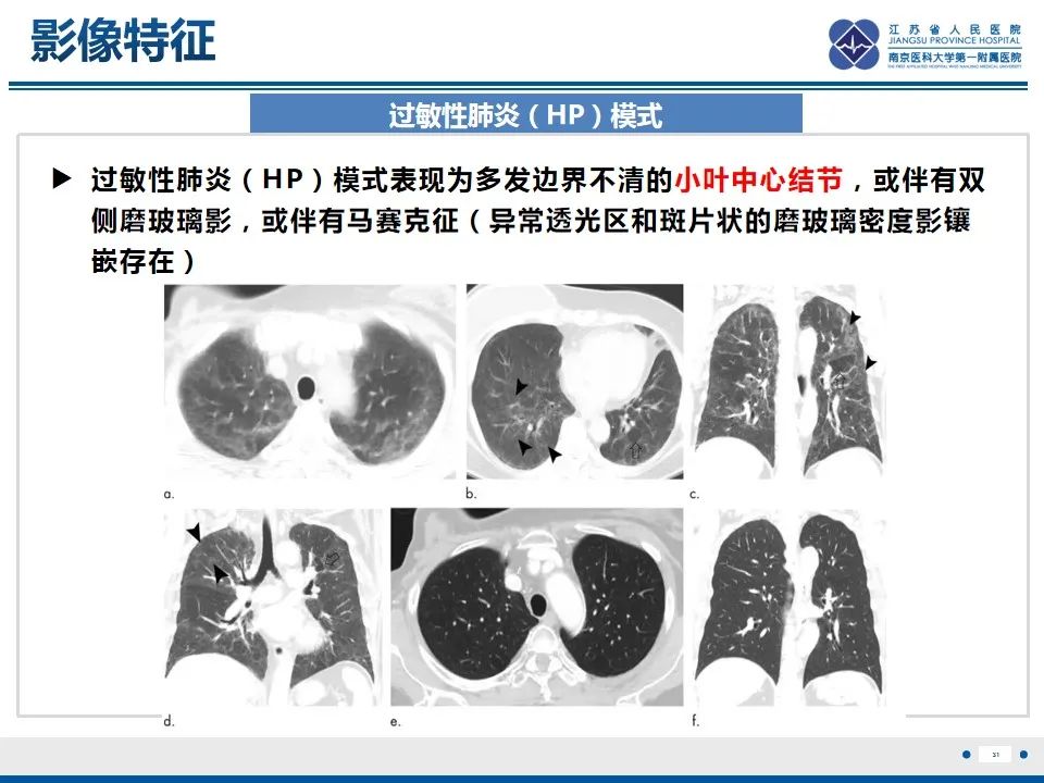 影像PPT - 【PPT】免疫检查点抑制剂相关性肺炎影像表现-32