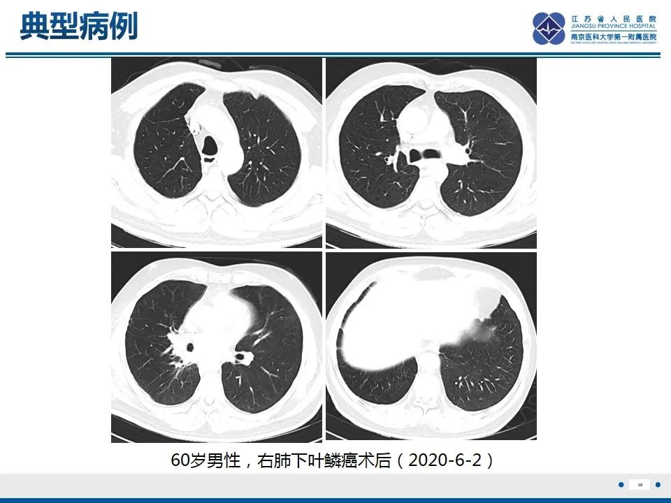 影像PPT - 【PPT】免疫检查点抑制剂相关性肺炎影像表现-39