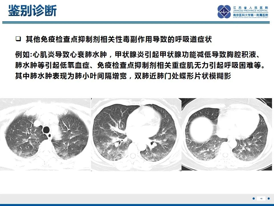 影像PPT - 【PPT】免疫检查点抑制剂相关性肺炎影像表现-43