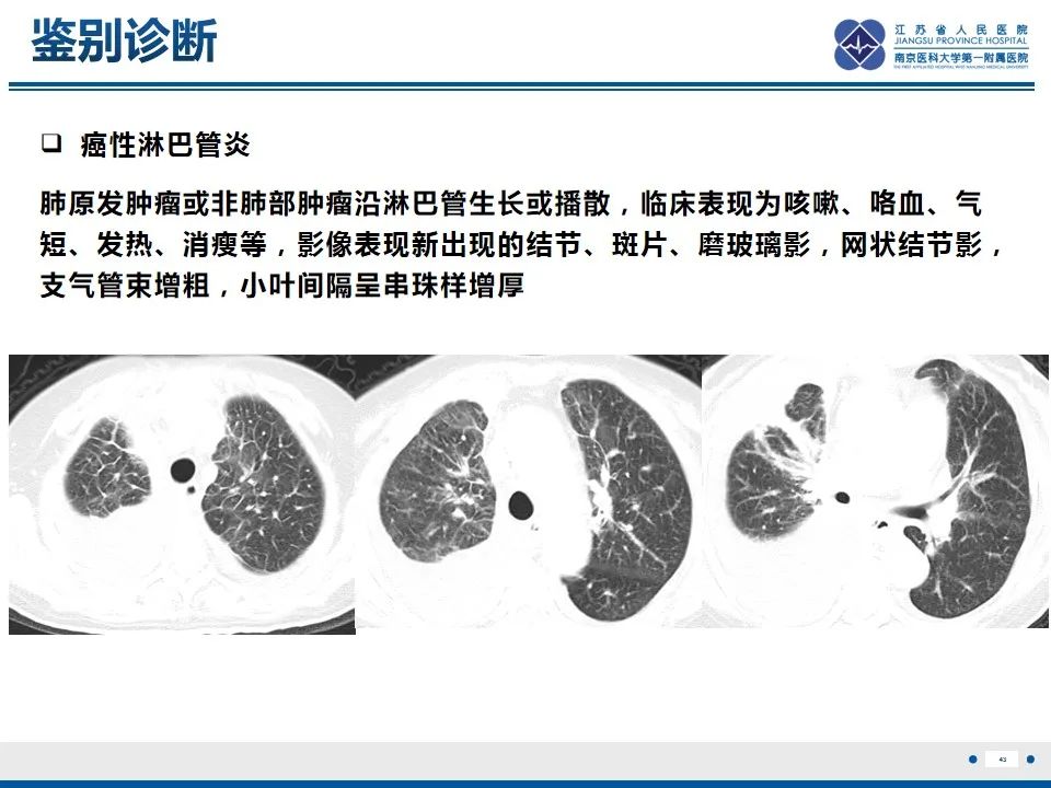 影像PPT - 【PPT】免疫检查点抑制剂相关性肺炎影像表现-44