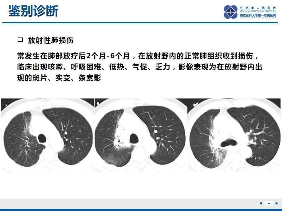 影像PPT - 【PPT】免疫检查点抑制剂相关性肺炎影像表现-45