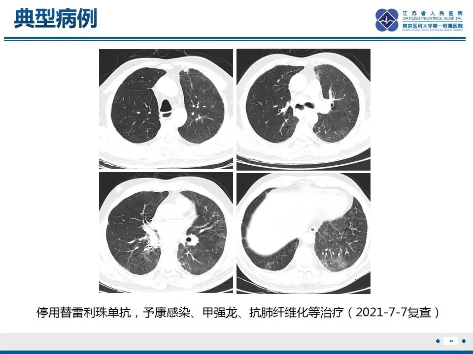 影像PPT - 【PPT】免疫检查点抑制剂相关性肺炎影像表现-41