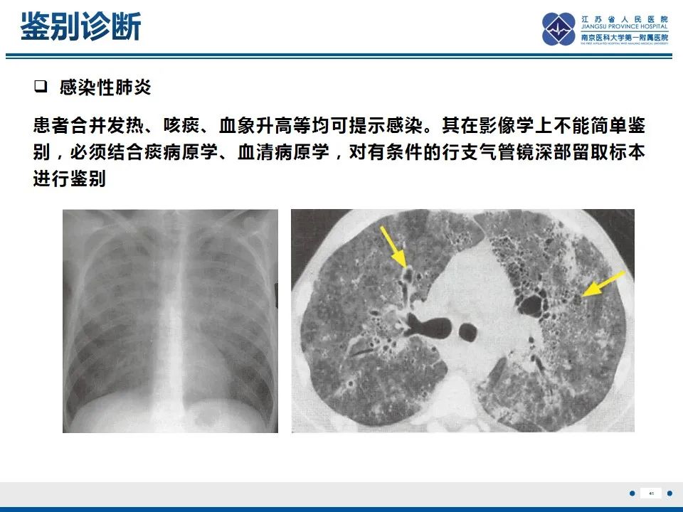 影像PPT - 【PPT】免疫检查点抑制剂相关性肺炎影像表现-42
