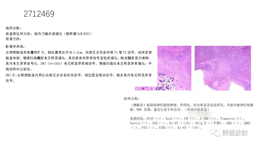 影像PPT - 【病例】侧脑室中枢神经细胞瘤2例MR-22