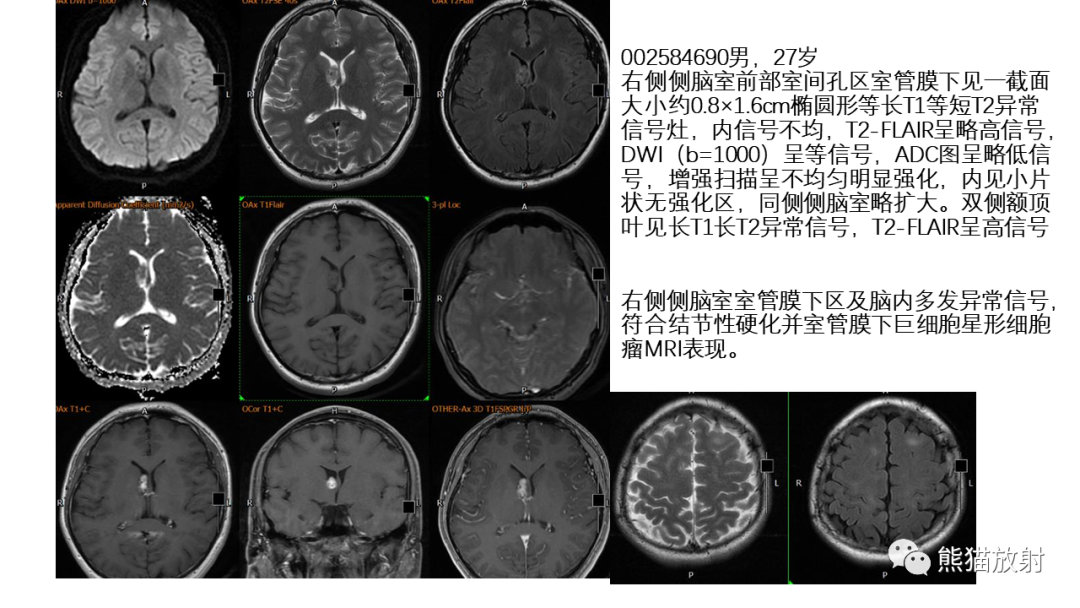 影像PPT - 【病例】侧脑室中枢神经细胞瘤2例MR-30