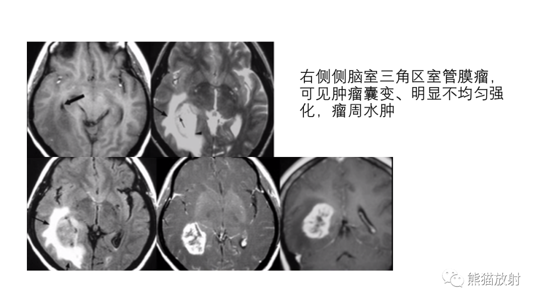 影像PPT - 【病例】侧脑室中枢神经细胞瘤2例MR-35