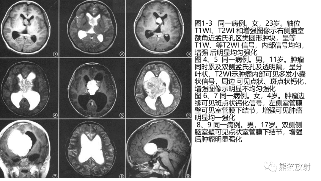 影像PPT - 【病例】侧脑室中枢神经细胞瘤2例MR-31