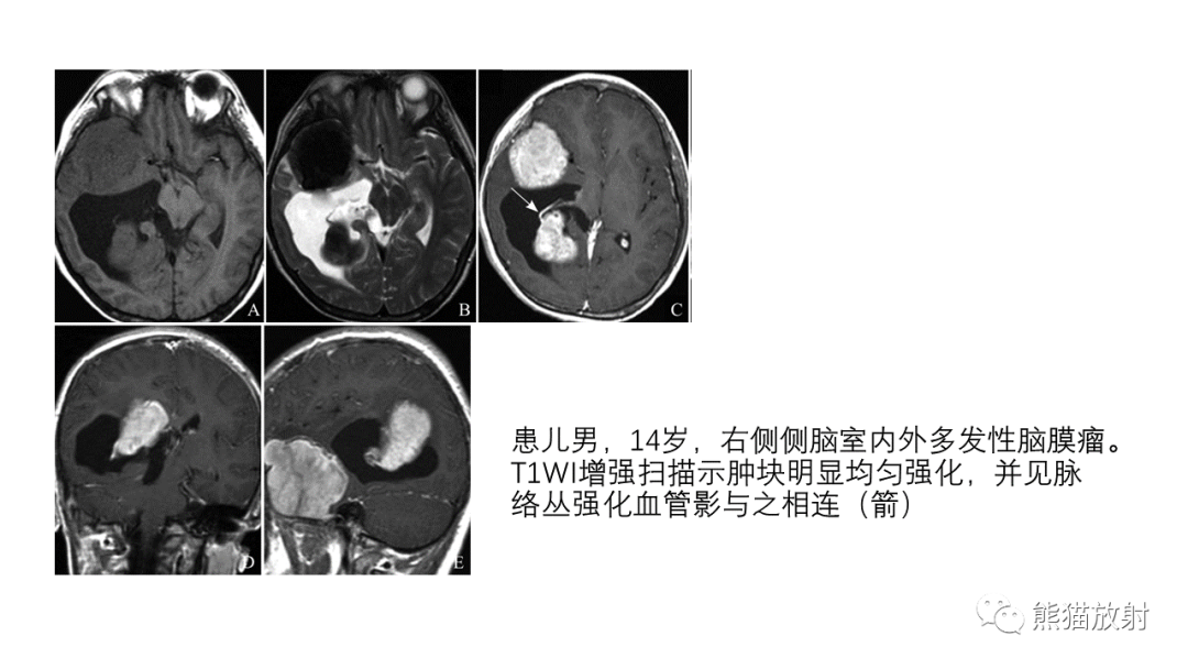 影像PPT - 【病例】侧脑室中枢神经细胞瘤2例MR-39