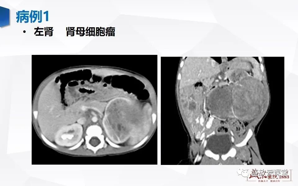 影像PPT - 【PPT】肾脏肿瘤影像诊断思辨（二）-14