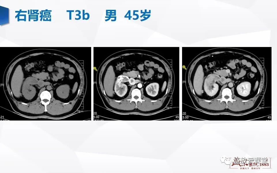 影像PPT - 【PPT】肾脏肿瘤影像诊断思辨（二）-19