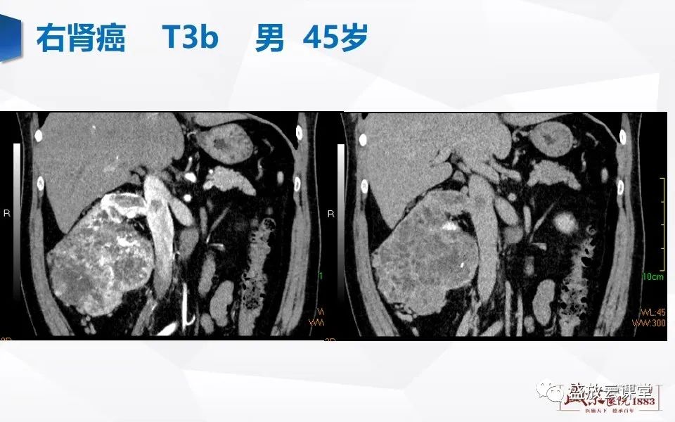 影像PPT - 【PPT】肾脏肿瘤影像诊断思辨（二）-20