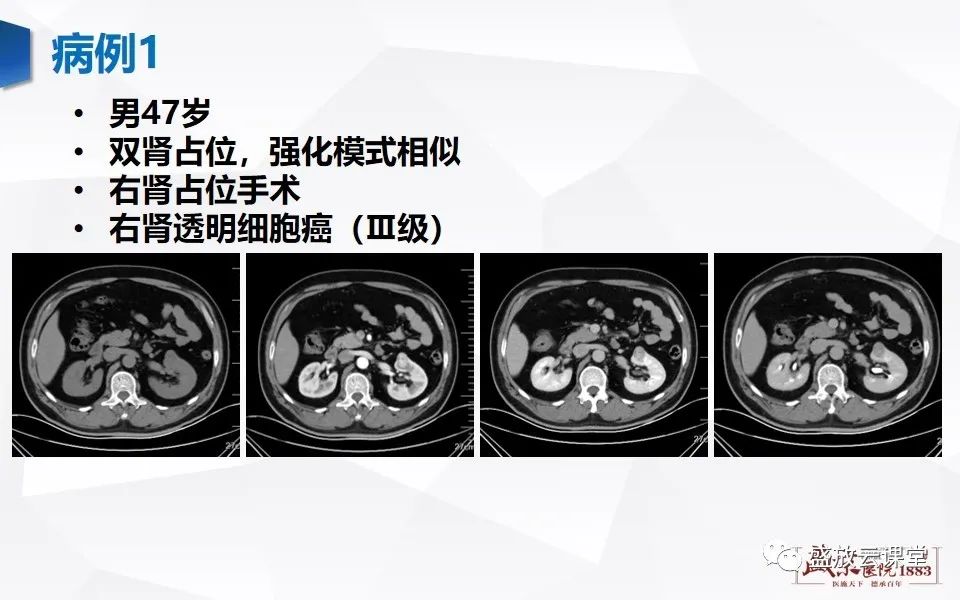 影像PPT - 【PPT】肾脏肿瘤影像诊断思辨（二）-28