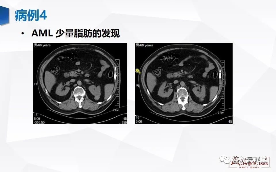 影像PPT - 【PPT】肾脏肿瘤影像诊断思辨（二）-33