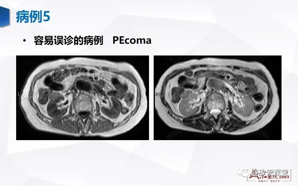 影像PPT - 【PPT】肾脏肿瘤影像诊断思辨（二）-35