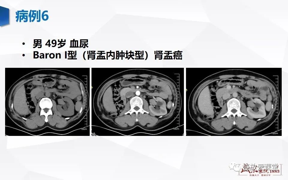 影像PPT - 【PPT】肾脏肿瘤影像诊断思辨（二）-37