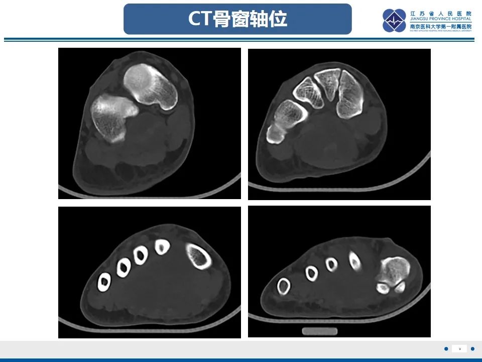 影像PPT - 【PPT】黏液炎性纤维母细胞性肉瘤-4