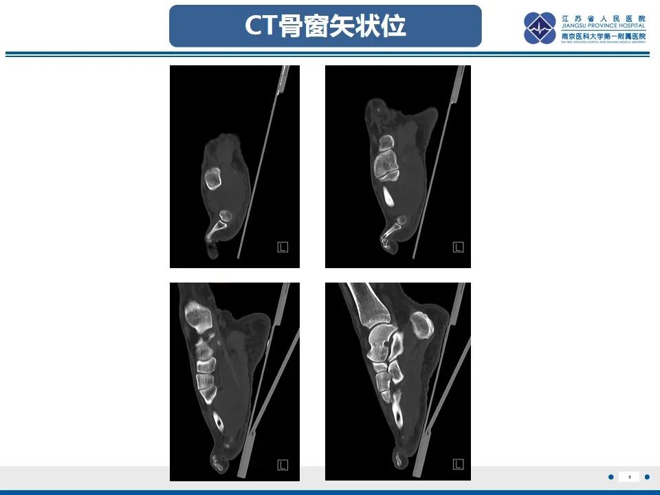 影像PPT - 【PPT】黏液炎性纤维母细胞性肉瘤-6