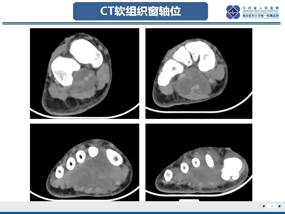 影像PPT - 【PPT】黏液炎性纤维母细胞性肉瘤-5