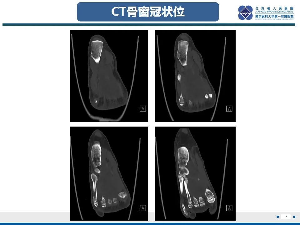影像PPT - 【PPT】黏液炎性纤维母细胞性肉瘤-8