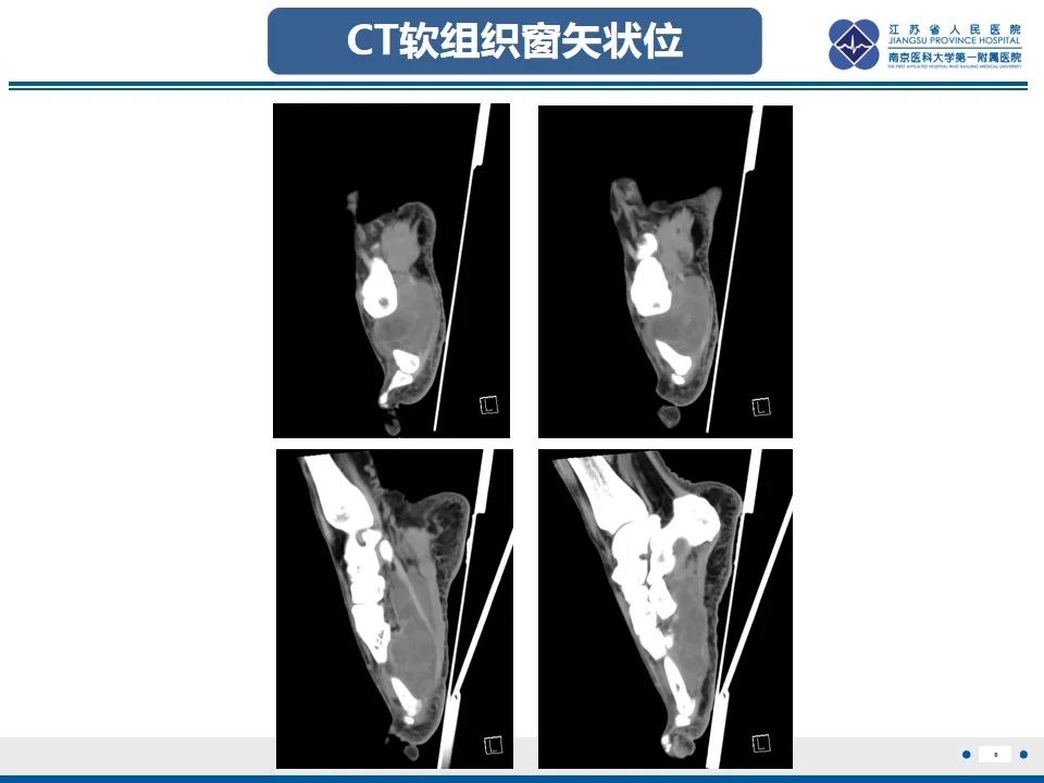 影像PPT - 【PPT】黏液炎性纤维母细胞性肉瘤-7