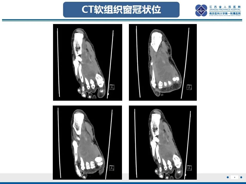 影像PPT - 【PPT】黏液炎性纤维母细胞性肉瘤-9