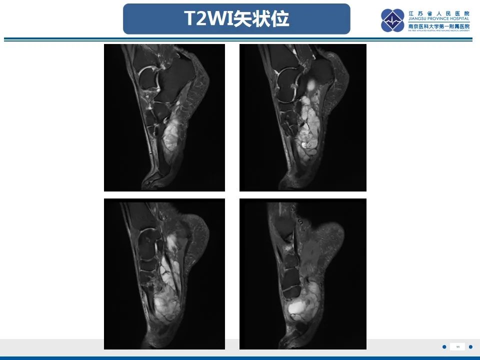 影像PPT - 【PPT】黏液炎性纤维母细胞性肉瘤-12