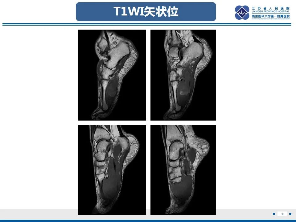 影像PPT - 【PPT】黏液炎性纤维母细胞性肉瘤-13