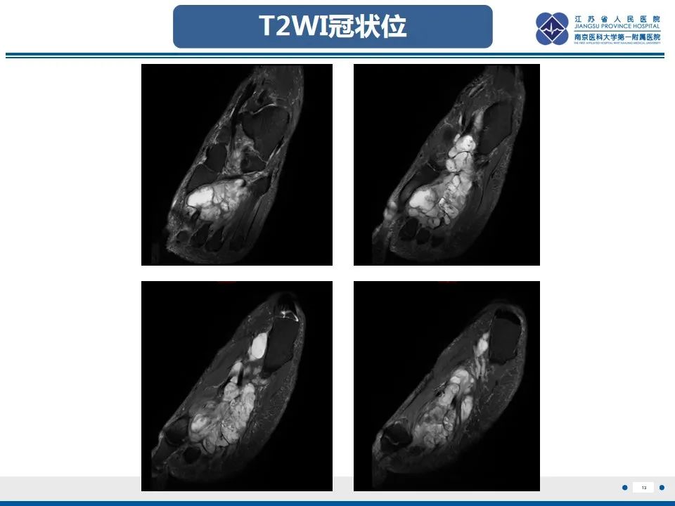 影像PPT - 【PPT】黏液炎性纤维母细胞性肉瘤-14