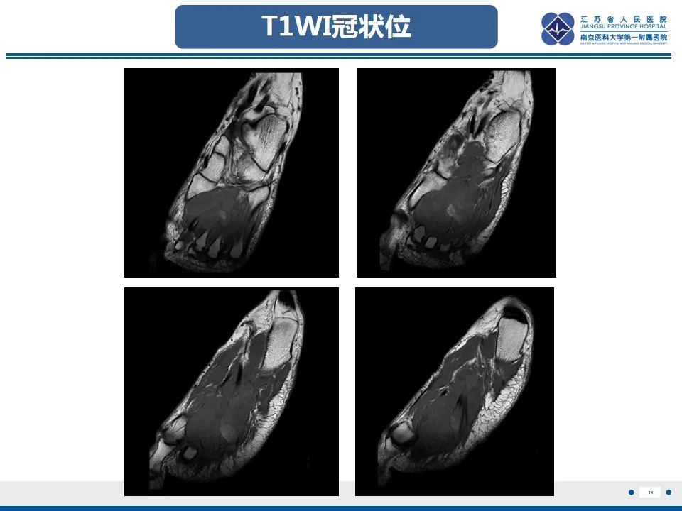 影像PPT - 【PPT】黏液炎性纤维母细胞性肉瘤-15