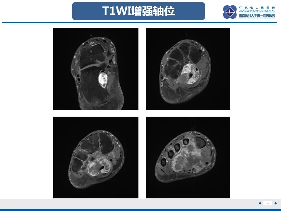 影像PPT - 【PPT】黏液炎性纤维母细胞性肉瘤-16
