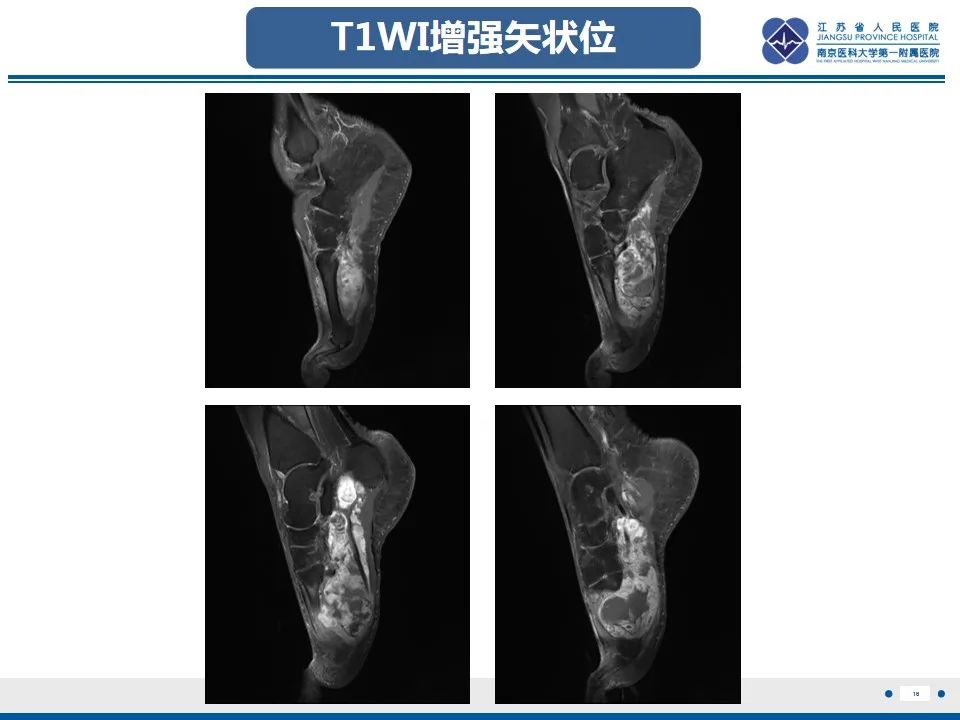影像PPT - 【PPT】黏液炎性纤维母细胞性肉瘤-17
