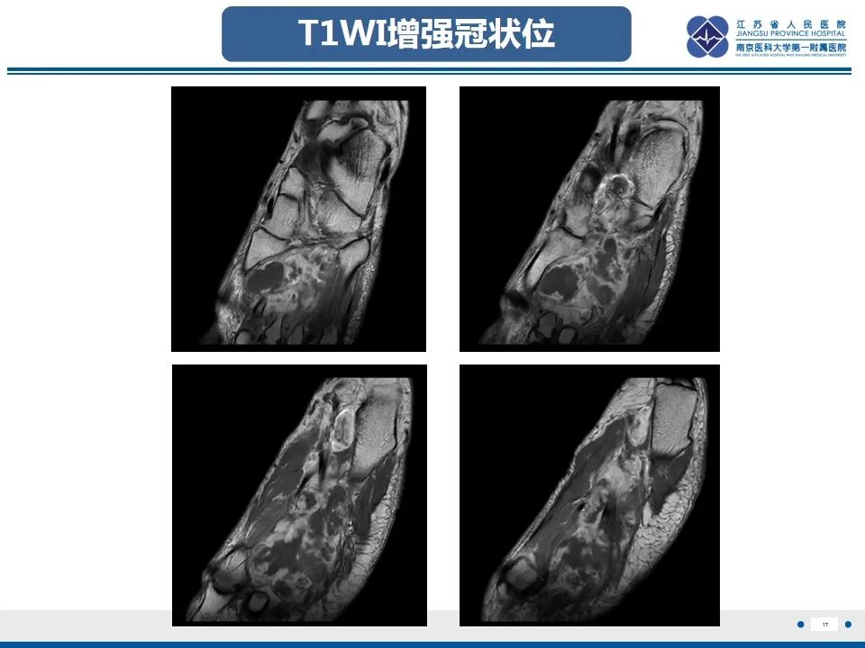 影像PPT - 【PPT】黏液炎性纤维母细胞性肉瘤-18