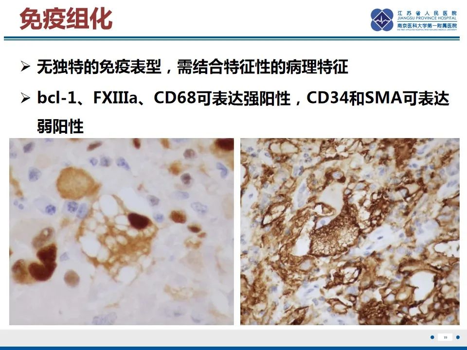 影像PPT - 【PPT】黏液炎性纤维母细胞性肉瘤-34