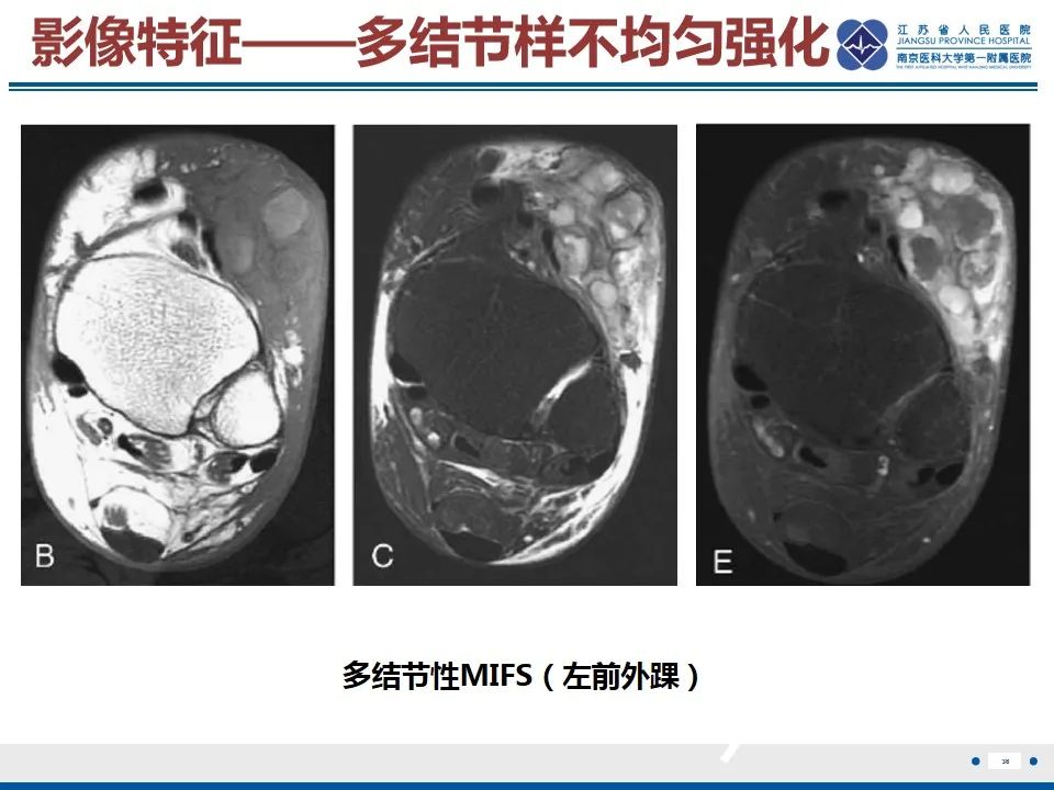 影像PPT - 【PPT】黏液炎性纤维母细胞性肉瘤-37
