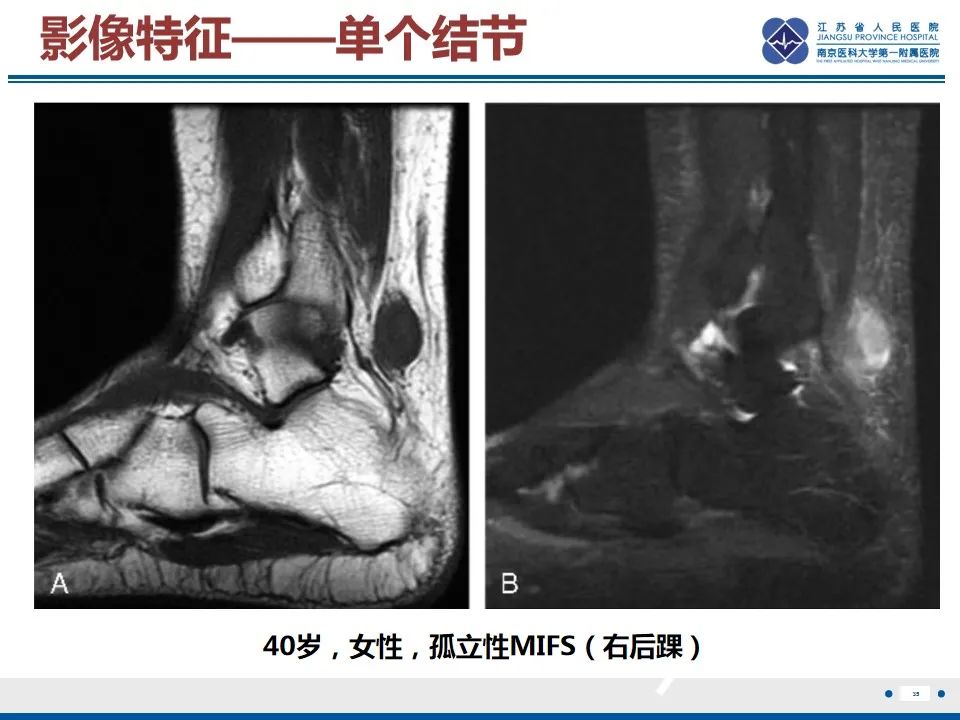 影像PPT - 【PPT】黏液炎性纤维母细胞性肉瘤-36