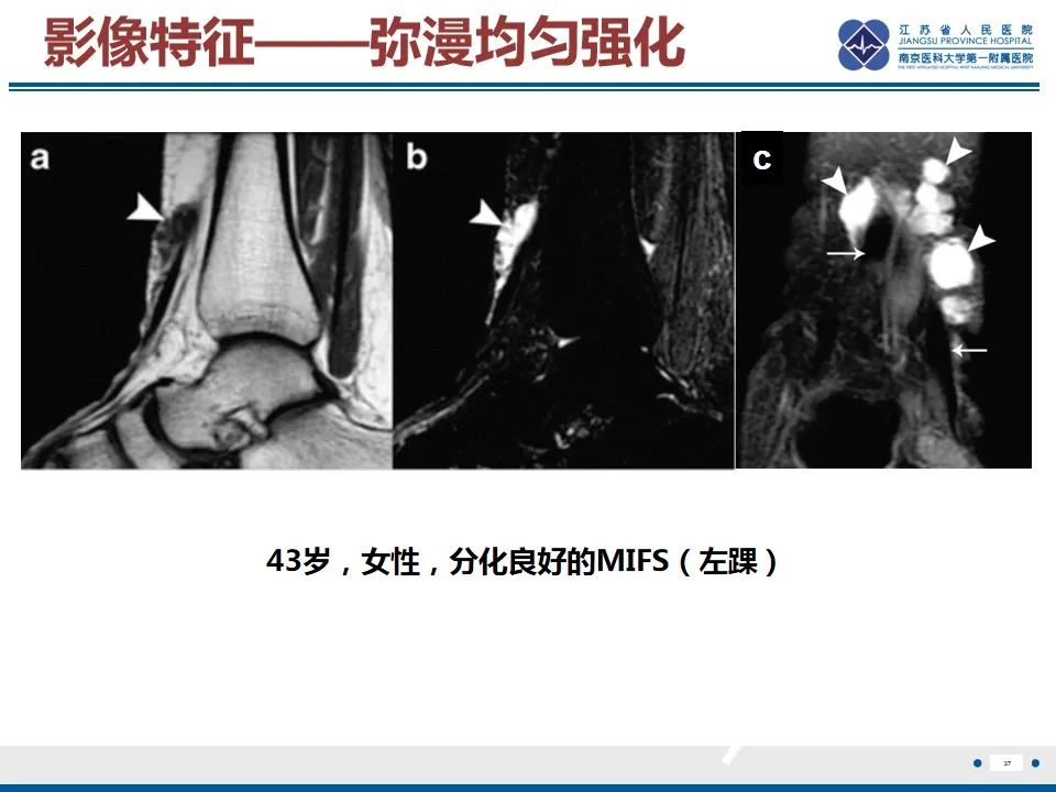 影像PPT - 【PPT】黏液炎性纤维母细胞性肉瘤-38