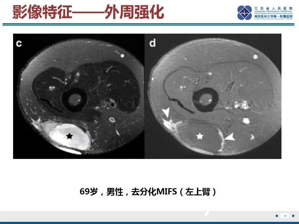 影像PPT - 【PPT】黏液炎性纤维母细胞性肉瘤-39