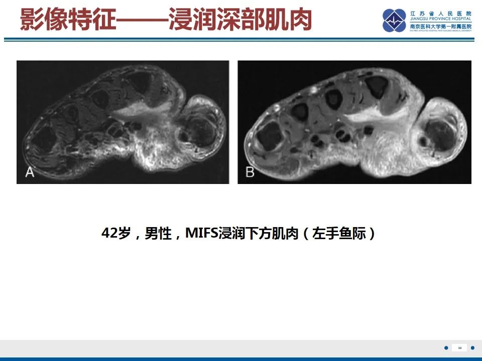 影像PPT - 【PPT】黏液炎性纤维母细胞性肉瘤-40