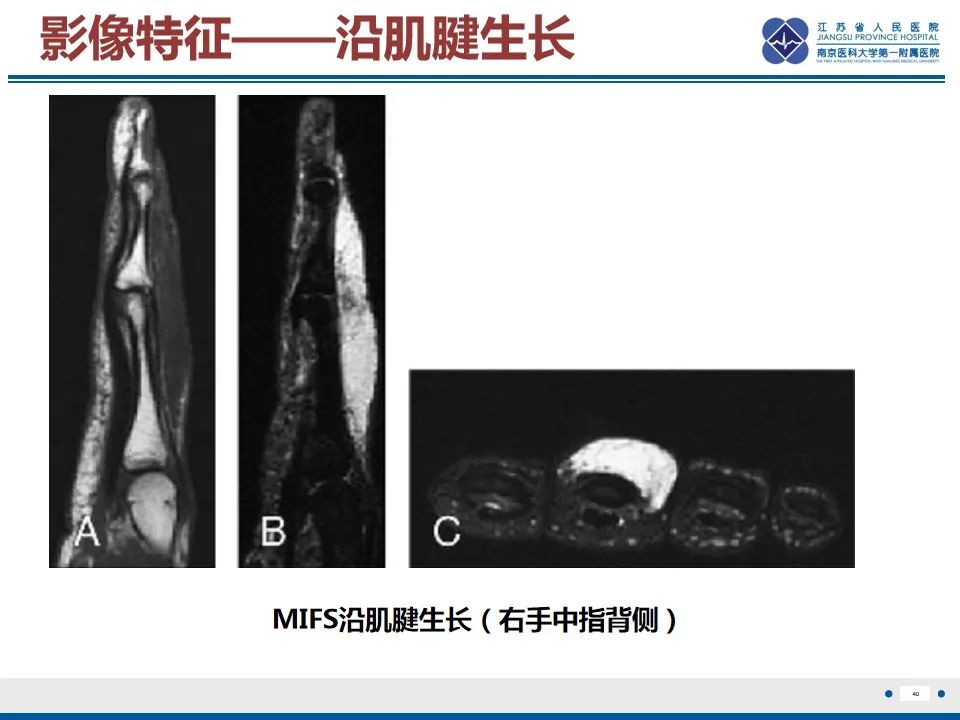 影像PPT - 【PPT】黏液炎性纤维母细胞性肉瘤-41